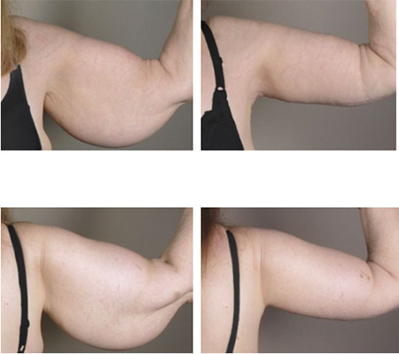 Brachioplasty (Arm Lift): Surgery, Recovery & What To Expect